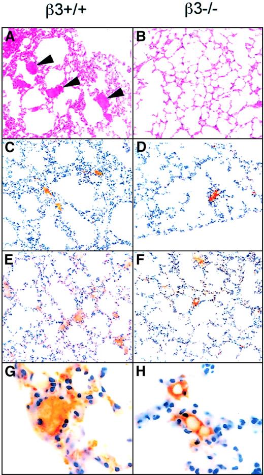 Fig. 7. Histology and immunohistochemistry with antibodies to platelets and fibrin(ogen) reveal increased platelet- and fibrin(ogen)-rich thrombi in the lungs of β3+/+ mice injected with collagen + epinephrine as compared to β3−/− mice. / Mice were injected with collagen + epinephrine, and 3 minutes later sections of lung tissue were stained with hematoxylin and eosin (panels A-B, 40 ×). Arrowheads point to thrombi in the pulmonary vasculature of a β3+/+ mouse; thrombi were present in the central and peripheral fields of the lung. Fewer thrombi were present in β3−/− mice, and, in the β3−/− mice, the thrombi (more than 70%) tended to be confined to the periphery of the lung tissue. Immunohistochemistry demonstrated that the thrombi were composed of fibrin(ogen) (C-D) and platelets (brown staining; E-F, 40 ×; G-H, 100 ×).