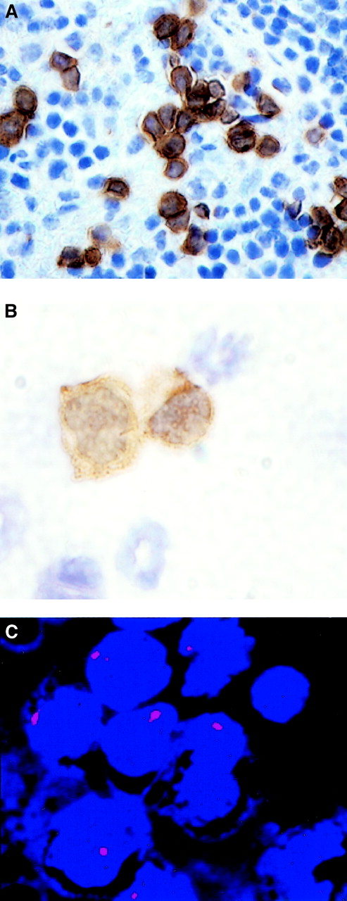 Fig. 5. Generation of AML-like disease by human CD34low/− SP cells in the NOD/SCID mouse. / Leukemic blasts staining positively for human CD45 were found infiltrating the murine host spleen (panel A, 60 ×) and the bone marrow (panel B, 100 ×). FISH with a centromeric probe for chromosome 7 (D7Z1) showed monosomic blasts infiltrating the bone marrow of this mouse (panel C, 100 ×).