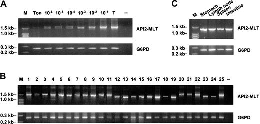 Fig. 2. Detection of t(11;18)(q21;q21) by RT-PCR of the API2-MALT1 fusion transcript. / (A) Sensitivity of RT-PCR for detection of the API2-MALT1 fusion transcript. Tumor cells harboring t(11;18)(q21;q21) were serially diluted with tonsillar cells and were then subjected to RNA extraction and RT-PCR. Using the first set of PCR primers (API2-1 and MALT1), the API2-MALT1 fusion transcript was detectable when the t(11;18)(q21;q21)-positive cells were diluted down to a concentration of 1 in 106 tonsillar cells. M, molecular weight marker; Ton, tonsillar cell; 10−6 to 10−1, various tumor cell concentrations; T, undiluted tumor cells; −, negative control. (B) T(11;18)(q21;q21)-positive MALT lymphoma. The number corresponds to the case number in Table 2. −, negative control. (C) Case 16 shows an identically sized API2-MALT1 product between the primary gastric MALT lymphoma and the tumor-involved lymph node, spleen, and small intestine.