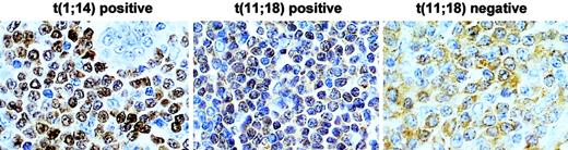 Fig. 4. Comparison of BCL10 protein expression between MALT lymphomas with and without t(11;18)(q21;q21). / T(11;18)(q21;q21)-positive case shows BCL10 (brown) nuclear expression in most of tumor cells, whereas the negative case displays cytoplasmic BCL10 expression. The level of BCL10 nuclear expression in t(11;18)(q21;q21)-positive cells is much lower than that in t(1;14)(p22;q32)-positive cells. Original magnification, × 650. Sections were counterstained with hematoxylin.
