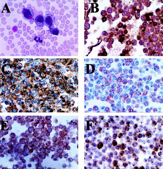 Fig. 1. The malignant blasts have the morphology and immunohistochemical features of ALCL cells. / (A) Wright stain of peripheral blood smear. Sections created from cell blocks of the leukopheresis product stain positive with monoclonal antibodies directed against (B) MPO, (C) CD30, (D) EMA, (E) ALK, and (F) granzyme B. Note that ALK staining is present only in the cytoplasm of the malignant cells (E).