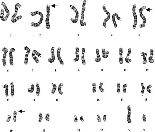 Fig. 3. G-banded karyotype from leukemic clone demonstrates structural abnormalities of chromosome homologues 2, 5, and 19. / Arrows denote the abnormal chromosome 2, 5, and 19 homologs. FISH (see Figure 4) resolved the karyotype as 46, XY, t(2;19)(p23;p13.1), der(5)t(5;19)(p15.3;q13.1).