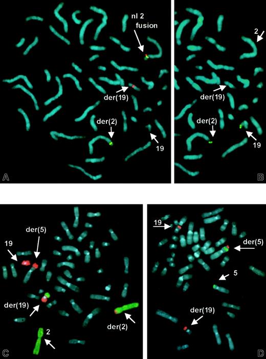 Fig. 4. FISH demonstrates. / ALK rearrangement, t(2;19), and der(5)t(5p;19q).(A) ALK split-apart FISH probe shows normal fused orange/green signal on normal No. 2 homologue, and split green signal on der(2) and orange signal on der(19). (B) Same metaphase rehybridized with 19p subtelomeric sequences, showing translocation of 19ptel to der(2). (C) FISH with dual-color whole chromosome paint probes shows No. 19 sequences (orange) translocated to der(2) and der(5) and No. 2 sequences (green) on der(19). (D) Subtelomeric sequences for 5p (green) and 19q (orange) show retention of 5ptel on der(5), and 19qtel translocated distal to 5ptel.