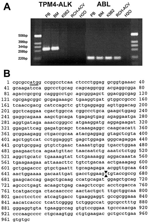 Fig. 5. The t(2;19)(p23;p13.1) fuses. / TPM4 to ALK. (A) Photograph of ethidium bromide–stained gel of RT-PCR products. An approximately 300-bp product was amplified with primers for TPM3 andALK from patient peripheral blood (PB) and bone marrow (BM), whereas no product was amplified from control cell lines K562 and RCH-ACV, or from a water-negative control. The results of control RT-PCR analyses for a portion of the ABL complementary DNA, verifying the integrity of isolated RNA, are shown at right. (B) Nucleotide sequence of amplified portion ofTPM4-ALK complementary DNA obtained usingTPM4-specific and ALK primers. The initiation codon in TPM4 is underlined and arrows denote the point of fusion between TPM4 (nucleotides 1 > 670) andALK sequences (671 > 966).