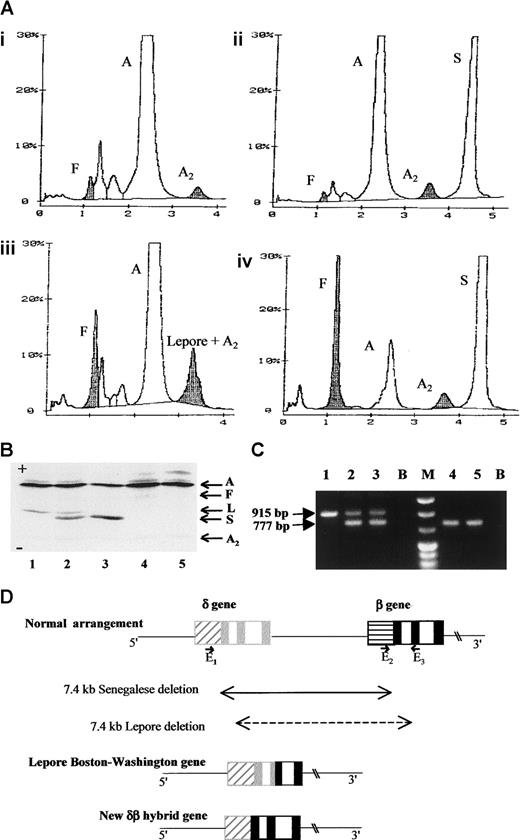 Fig. 1. Hemoglobin and DNA analysis of the Senegalese δ0β+thalassamia and the rearranged gene structure of the novel fusion gene. / (A) High-performance liquid chromatography (variant system, Biorad Laboratories, Richmond, CA) profiles of the hemolysates from the proband's father (i), mother (ii), a control sample of Hb Lepore heterozygote (iii), and the proband (iv). In this system, Hb Lepore migrates at the position of HbA2. The level of the proband's HbA was assessed to be 11.7% of total hemoglobin. (B) Isoelectrofocusing profiles of the following hemolysates from a control sample of Hb Lepore heterozygote (1), in vitro mixed HbA/ Hb Lepore and HbA/HbS (2), mother (3), father (4), and a healthy individual (5). Hb Lepore is clearly distinguished from HbS and no Hb Lepore was detected in the father even after overloading. (C) Agarose electrophoretic profile of the PCR products. PCR products obtained by using primers8 E1, 5′GACACACATGACAGAA CAGCCAAT3′; GenBank coordinates: 54586-54610; E25′CGATCTTCAATATGCTTACCAAG3′; coordinates: 61848-61870; and E3 5′CATTCGTCTCTTTCCCATTCTA3′, coordinates: 62763-62742 are in lanes 1 to 3 and those with E1 and E3, in lanes 4 and 5. In this system, the E2-E3 pair generates a 915-bp fragment for a normal β-globin gene and the E1-E3 pair, a 777-bp fragment for Lepore-type chromosome, whereas E1-E3 are too far to produce a PCR fragment under our experimental conditions. The template DNA used is from the proband's mother (lane 1), the father (lanes 2 and 4), and an individual heterozygous for Hb Lepore (lanes 3 and 5). (D) Schematic representation of the normal human δ- and β-globin gene arrangement, the Lepore Boston-Washington gene, and the herein described δβ fusion gene. The boxes, ▨ and ░, respectively represent the δ-globin gene promoter and exons and, ▤ and ▪, respectively represent the β-globin gene promoter and exons. The position and orientation of the E1, E2, and E3 primers are also indicated. A indicates HbA; F, HbF; A2, HbA2; S, HbS; L, Hb Lepore; B, PCR blanks; M, molecular size marker.