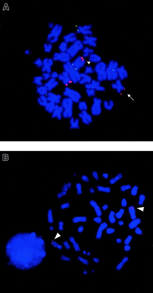 Fig. 1. FISH analysis of NUP98 rearrangement and chromosomal mapping of humanNSD1 gene. / (A) FISH using PAC 1173K1 (containing NUP98 gene) shows that this probe hybridizes to the normal chromosome 11, der(11) (arrow) and the der(5) (arrowhead), seen as red fluorescent signals in bone marrow metaphase from patient no. 3. The probe showing green fluorescent signals is the control 5p probe (cos113-1) used to identify both chromosomes 5. The same FISH result was also seen in metaphases from patient no. 1. (B) FISH using a cDNA clone of human NSD1 (Image clone 2621298) as a probe on normal peripheral blood metaphase shows that this novel gene localizes to 5q35 (red fluorescent signals) (arrowhead).