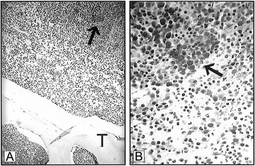 Fig. 1-1. Expression of VEGF in ALIP. / Bone marrow trephine biopsy from a patient with myelodysplastic syndrome demonstrating expression of VEGF in myeloblast clusters (arrows). T indicates trabecular bone. Panel A, 250 × magnification; panel B, 1000 × magnification.