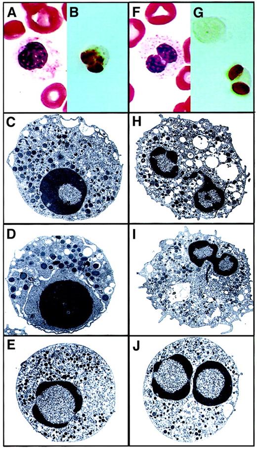 Fig. 1. Pseudo Pelger-Huët anomaly forms. / Panels A through E depict the Stodtmeister, or unilobed, form. Early granulocyte with coarse chromatin segregated toward the periphery of the nucleus. (A) PB Giemsa from an MDS patient (magnification × 100). (B) ISEL showing a pseudo Pelger-Huët cell undergoing apoptosis (magnification × 100). (C-E) Electron micrographs showing the classical apoptotic features (uranyl acetate and lead citrate staining; original magnifications, × 6600, × 10 000, and × 6600, respectively). Panels F through J depict the bilobed form. Mature neutrophil showing bilobed nucleus with marked chromatin condensation and altered cytoplasm. (F) PB Giemsa from an MDS patient (magnification × 100). (G) ISEL showing a pseudo Pelger-Huët cell undergoing apoptosis (magnification × 100). (H- J) Electron micrographs showing the classical apoptotic features (uranyl acetate and lead citrate staining; original magnifications, × 8300, × 6600, and × 6600, respectively).