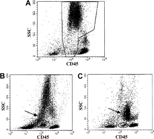 Fig. 1. Myeloid abnormalities in MDS demonstrated by CD45 versus side light scatter. / Data from patients with straightforward myelodysplastic syndrome, diagnosed by morphology. (A) Healthy donor bone marrow: normal granulocytes and precursors in the boxed region. (B) MDS patient bone marrow (ungated): hypogranular neutrophils with low side scatter (arrow) and a discrete blast population (oval) are demonstrated. (C) MDS patient bone marrow (ungated): hypogranular neutrophils with low side scatter (arrow) and a discrete blast population (oval) are demonstrated.