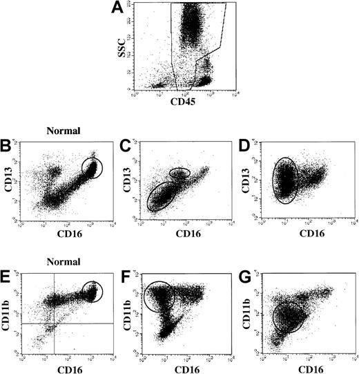 Fig. 2. Immunophenotypic myeloid abnormalities in MDS. / (A) Analysis gate used: the analysis gate used is based on CD45 (x-axis) versus side light scatter (SSC, y-axis) and includes granulocytes and precursors (CD45 dim and spectrum of SSC) and is demonstrated in the boxed region of this healthy donor bone marrow. (B) Healthy donor bone marrow. FITC-CD16 (x-axis) versus PE CD13 (y-axis). Oval indicates the majority of cells in this gate in normal bone marrow. (C-D) MDS patient bone marrow: FITC-CD16 (x-axis) versus PE CD13 (y-axis). Ovals highlight abnormal populations. (E) Healthy donor bone marrow. FITC-CD16 (x-axis) versus PE CD11b (y-axis). Oval indicates the majority of cells in this gate in normal bone marrow. (F-G) MDS patient bone marrow: FITC-CD16 (x-axis) versus PE CD11b (y-axis). Ovals highlight abnormal populations.