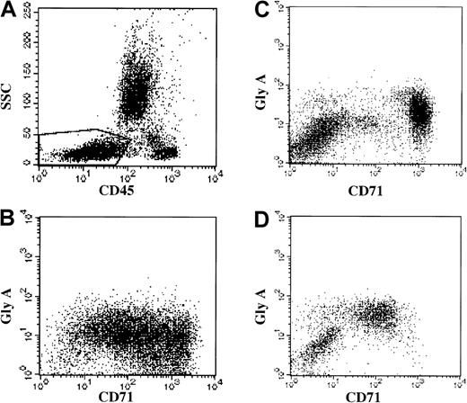 Fig. 3. Immunophenotypic erythroid abnormalities in MDS. / (A) Analysis gate used: the analysis gate used includes nucleated red cell precursors (CD45 dim to negative and low SSC) and is demonstrated in the boxed region of this bone marrow. (B) Healthy donor bone marrow: there is high-level staining for the transferrin receptor (FITC-CD71, x-axis) in the glycophorin A–positive (GLY A, y-axis) nucleated erythroid cells. (C) MDS patient bone marrow: FITC-CD71 (x-axis) versus PE anti–glycophorin A (y-axis). There is a broad spectrum of CD71 expression—from normal to very low. (D) MDS patient bone marrow: FITC-CD71 (x-axis) versus PE anti–glycophorin A (y-axis). There is decreased CD71 expression in the glycophorin A–positive cells.