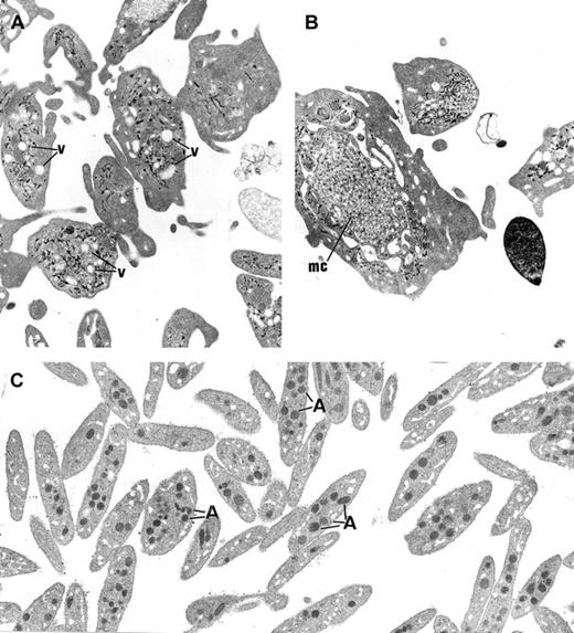 Fig. 3. Ultrastructure of platelets. / (A) In GPS, normal α-granules are absent from the platelets and replaced by vacuolar structures (v) the size of normal α-granules. (B) Platelets of large size displaying membrane complex (mc) and devoid of normal α-granules are encountered. (C) Platelets from a normal subject are smaller and display conspicuous α-granules (A). (Panels A-C, original magnification × 10 500.)