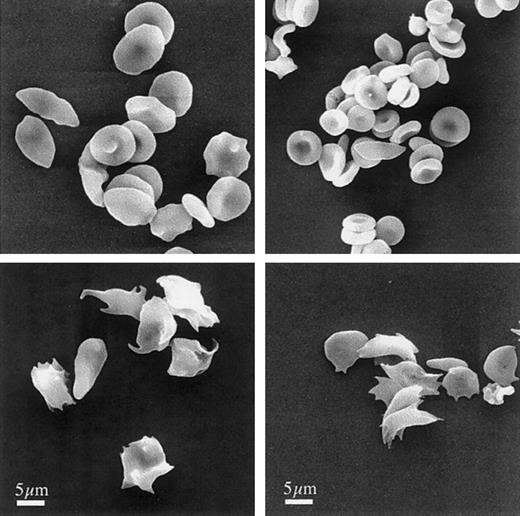 Fig. 1. Morphology of murine sickle cells mimics human sickle cells. / Human (left) and murine (right) RBCs were fixed under oxygenating (top) or during deoxygenating conditions (bottom), as described in “Materials and methods.” After processing, the cells were examined by scanning electron microscopy. Bar indicates 5 μm.