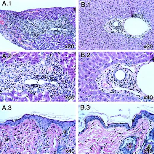 Fig. 2. Anti-GVHD activity of the JAK3 inhibitor WHI-P131. / (A.1, A.2) Histopathologic examination of the liver from the representative vehicle-treated control C57BL/6 (H-2b) mouse transplanted with a BALB/c (H-2d) BM/S graft, killed on day 30 after BMT, revealed a severe, predominantly lymphocytic, inflammatory reaction around the portal area with destruction of bile ducts. (A.3) Skin GVHD with focal pyknotic cells and vacuolation in the basal cell layer of the epidermis in skin of the same mouse. (B.1, B.2) Histopathologic examination of the liver from the representative WHI-P131–treated C57BL/6 (H-2b) mouse transplanted with a BALB/c (H-2d) BM/S graft, killed on day 30 after BMT, revealed a mild lymphocytic infiltration of the portal area without a bile duct infiltration and destruction. (B.3) Normal-appearing skin in the same mouse.