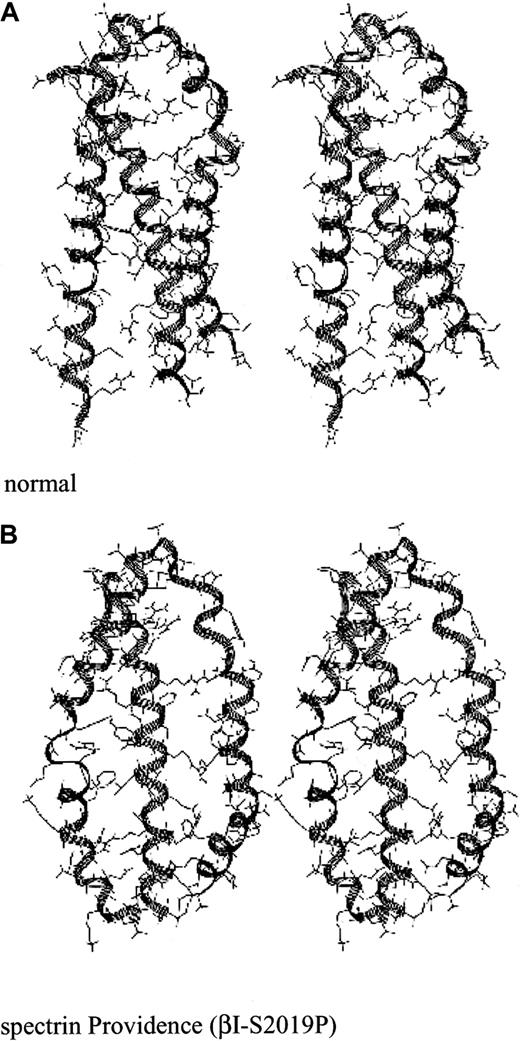 Fig. 5. Stereo drawing of the spectrin Providence mutation. / (A) Predicted structure of the normal self-association unit. (B) Predicted structure of the self-association unit in spectrin Providence. This spectrin mutation leads to severe hemolytic disease and erythroblastosis fetalis in the homozygous state.37