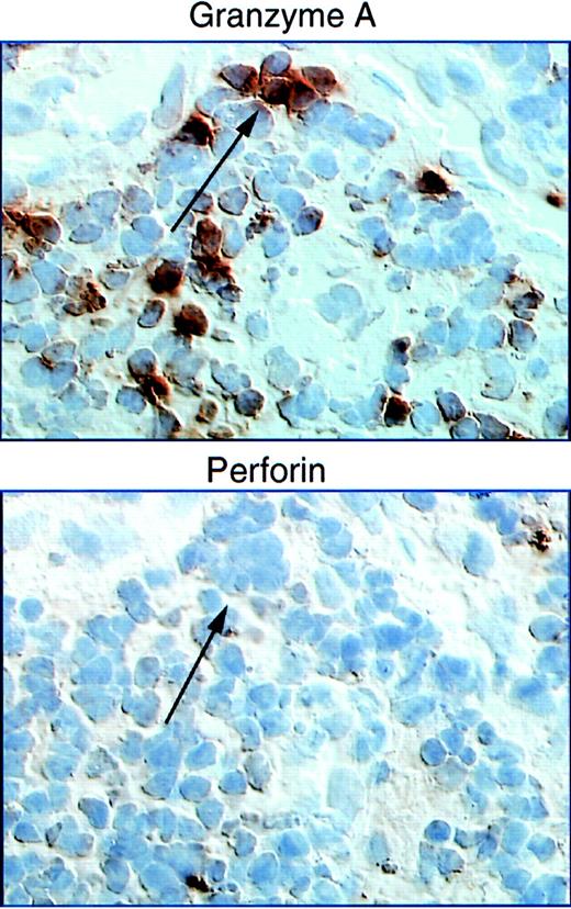 Fig. 2. Perforin staining is reduced compared with staining for GzmA in adjacent LN sections from a donor undergoing primary HIV infection. / In contrast, comparable levels of granzymes A and perforin were found in samples from acute infectious mononucleosis. Figure taken from Andersson et al113. Copyright 1999 and reprinted with permission from Lippincott Williams & Wilkins.