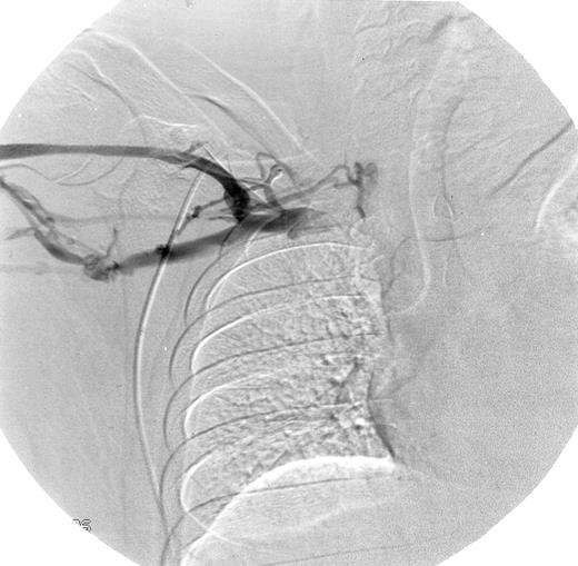 Fig. 1. Abnormal venogram. / Patient 14 had multiple collateral vessels in the right mid-subclavian region providing antegrade flow around the obstruction of the proximal subclavian vein.