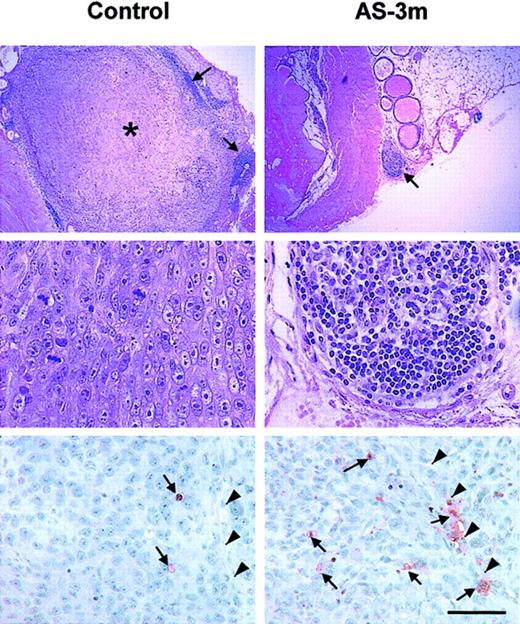 Fig. 8. Tumors of treated mice show reduced tumor size and increased apoptosis. / The top 4 panels are photomicrographs of hematoxylin and eosin–stained sections of PC-3 orthotopic tumors. Top and center left panels show that control mice treated with the diluent alone (PBS) reveal a large tumor (indicated by asterisk) encircled by immune cells (arrows) noted by dense nuclear stain (at lower power) and a high mitotic rate in the tumor at higher power. Top and center right panels show that VEGF AS-3–treated mice reveal a small tumor nodule within the prostate gland (arrow), showing infiltration with immune cells at higher power. Data representative of TUNEL staining for apoptosis in mice bearing human ovarian tumor are shown in the lower two panels. Mice treated with AS-3m show increased apoptosis in the cells lining the vascular structures and the tumor tissue (right panel). Mice receiving the diluent show substantially fewer apoptotic cells (left panel). Apoptotic cells stain red and are indicated by arrows; arrowheads indicate a tumor vessel. The scale bar represents 70 μm.