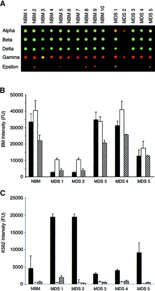Fig. 4. Globin gene expression patterns. / (A) α, β, δ, γ, and ε globin spots probed with Cy3-labeled probe from 10 normal bone marrow (NBM) and 5 MDS bone marrow (MDS) samples. In all cases, the Cy5-labeled probe was generated from the same pool of K562 erythroleukemia cell RNA. Graphic displays of the Cy3 (bone marrow–derived) and Cy5 (K562-derived) intensities for the adult globin genes are shown in panels B and C, respectively. The normal bone marrow (NBM)-derived and myelodysplastic bone marrow (MDS)-derived signal intensities are represented as means with SD bars. Key: α (solid bars), β (open bars), δ (hashed bars).