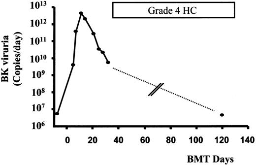 Fig. 4. Time course of HC and BK viruria in patient 1. / Peaking of BK viruria preceded the onset of HC by about 2 weeks. Quantification of BK viruria during severe HC on day 120 showed a low level of viruria. No urinary specimen was available for quantification from 32 to 120 days (dashed line) (see text).