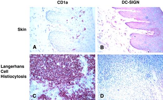 Fig. 1. DC-SIGN and Langerhans cell histiocyosis. / (A) Normal skin shows positive immunostaining for CDla on dendritic cells within the epidermis and at the dermo-epidermal junction. (B) Serial section of skin from panel A shows positive immunostaining for DC-SIGN on cells within the dermis only. No epidermal dendritic cells express DC-SIGN. (C) Langerhans cell histiocyosis from the retro-orbital region showing immunostaining for CDla on numerous large cells. (D) DC-SIGN staining of a serial section of the specimen in panel C shows no expression of DC-SIGN on these large CDla+ cells. Sections were immunostained using the peroxidase technique and counterstained with hematoxylin. Sections were photographed at × 100.