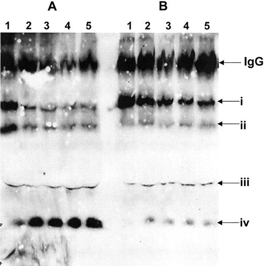 Fig. 1. Identification of the factor V molecule present in plasma. / Citrated plasma (100 μL) from a pool of normal plasma (A) and from patient I3 (Castoldi et al5, B) was diluted 10-fold in a buffer containing 5 mM CaCl2 and treated with phospholipid vesicles and APC (5 nM) as described.23 Immunoreactive fragments were detected using the monoclonal antibody αHFVaHC17 under nonreducing conditions.2 (A) Normal pool plasma; (B) plasma from patient I3 (Catoldi et al5). Lane 1, plasma immediately following clot formation and the addition of APC (5 nM, ∼20 sec); lanes 3-5 plasma at 5, 10, 20, and 30 min following the addition of APC. Roman numerals on the right indicate the following: (i) the heavy chain of factor Va following clot formation; (ii) the Mr 75 000 fragment deriving from cleavage of the heavy chain of factor Va at Arg506 (amino acid residues 1-506); (iii) the Mr 60 000 fragment that derives from factor Va following cleavage at Arg306 (amino acid residues 307-709); (iv) the Mr 30 000 fragment derived from normal factor Va following cleavage at Arg506 and Arg306 (amino acid residues 307-506). The position of the immunoglobulin G (IgG) molecules (nonreduced) is also shown.