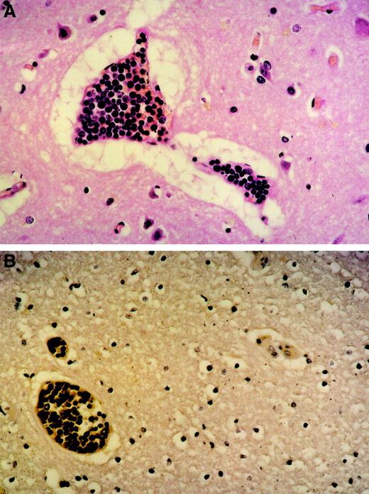 Fig. 1. Tumor cell agglutination within blood vessels. / Original magnification was × 100. (A) Brain (H&E stain) agglutination of large lymphoid blasts with abundant mitoses within small capillaries. Marked perivascular edema. (B) Brain (immunhistology) CD20 expression of the tumor cells within the blood vessels proving them to be of B lineage.
