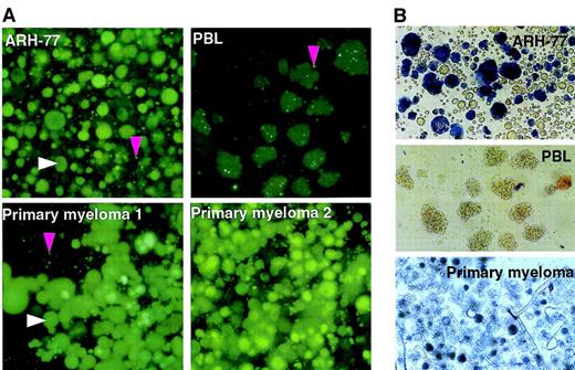 Fig. 1. Edmonston-B vaccine strain of measles virus (MV-Edm) replicates selectively in myeloma cells and induces potent cytopathic effects. / The ARH-77 myeloma cell line, human primary myeloma cells, and PHA-stimulated PBLs were infected with MV-eGFP (MOI, 1.0), photographed, and stained with trypan blue 96 hours later. The white arrow indicates a fluorescent syncytium, and the pink arrow indicates a single infected fluorescent cell. (A) At 48 hours after infection, the viable MV-infected ARH-77 cells and primary myeloma cells are identifiable as large fluorescent syncytia because of GFP expression under blue light. (B) Phase contrast reveals that at 96 hours after infection, many syncytia in the ARH-77 and primary myeloma cultures have died and lost the ability to exclude trypan blue. In comparison, MV-Edm replication in PHA-stimulated PBLs is restricted, and cytopathic effects are minimal.
