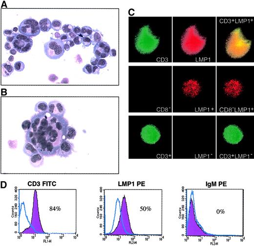 Fig. 6. Morphologic and phenotypical characterization of the C2174PBL cells. / (A,B) C2174PBL cell line cytospins after 20 months of culture; note the presence of multinucleated giant cells (Giemsa staining). Original magnification of each, × 40. (C) An aliquot of the C2174PBL cultured PBMCs permeabilized and then stained with rabbit specific antibodies (CD3 FITC, CD8 FITC) and EBV-LMP1 antibody (LMP1 PE) was fixed in paraformaldehyde placed in mounting media and analyzed using a Leica DMRA microscope (using program QFISH). Original magnification, × 63. The upper portion of panel C shows a double-positive cell for LMP1 and CD3. The dent present on the upper right corner clearly shows evidence of an adjacent double-negative cell. The middle panel shows an LMP1-positive and a CD8−cell, whereas the lower panel shows a CD3+ and an LMP1-negative cell. (D) Histogram plots from the FACS analysis of the C2174 cultured PBMCs at 20 months of culture. Blue lines indicate specific isotypic control.