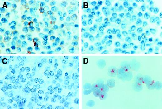 Fig. 3. Immunohistochemical and immunocytochemical detection of tryptase. / Expression of tryptase in AML blasts was demonstrated by immunostaining experiments using the anti-tryptase mAb G3 and bm sections or cytospin preparations (isolated MNCs). Immunostaining experiments were performed as described in the text. (A) A tryptase-stained bm section in a patient with AML M4eo (serum tryptase level, 881 ng/mL). As visible, many immature myeloid cells (blasts) in the bm reacted with anti-tryptase antibody. In other patients, only a few blasts were found to react with mAb G3. (B) The reactivity of blast cells with this mAb in a case of AML M2 (serum tryptase level, 41.6 ng/mL). In patients with AML without elevated tryptase and those with ALL, bm blasts appeared to be tryptase− by immunohistochemistry. (C) A bm section in a patient with ALL (serum tryptase level, 8.9 ng/mL) stained with mAb G3. Immunocytochemistry confirmed tryptase expression in AML blasts. (D) A cytospin preparation of bm MNCs prepared in a patient with AML M4eo (the same as in panel A). As visible, most of the AML blasts reacted with anti-tryptase mAb G3, confirming the immunohistochemical staining result (A). Note that most of the G3-reactive material is localized in the cytoplasm of AML blasts.