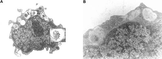 Fig. 5. Immunoelectron microscopy. / Immunoelectron microscopy was performed using isolated bm MNCs prepared in one patient with AML with a high tryptase level (A; AML M4eo; serum tryptase, 881 ng/mL) and in one patient with AML with a lower tryptase level (B; AML M4; serum tryptase, 224 ng/mL). Immunogold labeling was performed using anti-tryptase mAb G3 (for technical details see text). In the patient with elevated serum tryptase levels, G3-reactive material was detected in the (small) cytoplasmic compartment of AML blasts. Interestingly, tryptase was often found to localize to granulelike structures (A). Cases without elevated serum tryptase were consistently negative by immunoelectron microscopy (not shown).