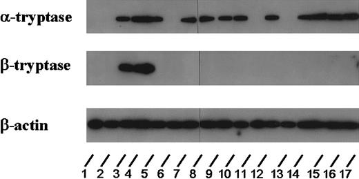 Fig. 6. Expression of tryptase mRNA in AML cells. / Northern blot experiments were performed on leukemic blasts in 17 patients corresponding to lanes 1 (ALL, 2.7 ng/mL), 2 (M0, 3.9 ng/mL), 3 (M4eo, 395 ng/mL), 4 (M4eo, 881 ng/mL), 5 (M0, 120 ng/mL), 6 (M1, < 1 ng/mL), 7 (M3, 122 ng/mL), 8 (M4eo, 177 ng/mL), 9 (M1, 56 ng/mL), 10 (M2, 4.6 ng/mL), 11 (M4eo, 15.9 ng/mL), 12 (M2, 113 ng/mL), 13 (M6, 5.5 ng/mL), 14 (M4, 23.1 ng/mL), 15 (M3, 79.2 ng/mL), 16 (M4, 224 ng/mL), and 17 (M3 55.5 ng/mL). For detection of tryptase mRNA, an oligonucleotide probe specific for α-tryptase and a second probe specific for β-tryptase were applied. For control purposes, the membrane was hybridized with an oligonucleotide probe specific for β-actin. Using the α-tryptase probe, tryptase mRNA could be detected in all cases with elevated serum tryptase levels. By contrast, β-tryptase mRNA was detectable only in a small group of patients analyzed (ie, in AML M4eo). In the 2 AML cases with normal serum tryptase as well as in one case with ALL (normal serum tryptase level), no tryptase mRNA could be detected.