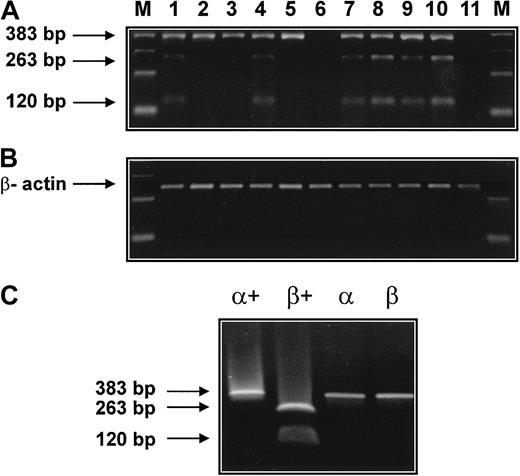Fig. 7. Detection of α- and β-tryptase mRNA by RT-PCR. / (A) RT-PCR was performed with bm RNA from 9 patients with AML. The respective lanes are 1 (M1, 20.5 ng/mL), 2 (M2, 41.6 ng/mL), 3 (M2, 26.9 ng/mL), 4 (M1, 4.1 ng/mL), 5 (M3, 55.5 ng/mL), 6 (M3, 6.2 ng/mL), 7 (M4eo, 77 ng/mL), 8 (M4eo, 15.7 ng/mL), and 9 (M4eo, 881 ng/mL). In all cases with elevated serum tryptase (lanes 1,2,3,5,7,8,9) and in one patient with normal serum tryptase (lane 4), tryptase cDNA of 383 bp was obtained by RT-PCR. Restriction enzyme digestion (Dra III) revealed the presence of β-tryptase cDNA in 5 of 9 patients with AML (restriction fragments of 263 bp and 120 bp). The human mast cell line HMC-1 (lane 10) but not human fibroblasts (lane 11) was also found to express α- and β-tryptase mRNA. β-Actin cDNA was obtained from all samples (B). RT-PCR products for α- and β-tryptase obtained from plasmids containing α- and β-tryptase cDNA were subjected to electrophoresis before (α, β) and after (α+, β+) digestion with Dra III (C).