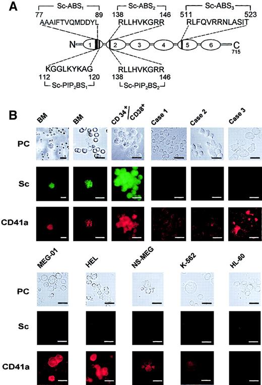 Fig. 1. Expression of antigen CD41a and scinderin in normal human bone marrow cells, cell lines, and cells from patients with acute megakaryoblastic leukemia. / (A) Schematic representation of scinderin (Sc) domains 1 to 6 shows amino acid sequences corresponding to the 3 actin-binding sites (Sc-ABS1, Sc-ABS2, and Sc-ABS3) and to the 2 PIP2-binding sites (Sc-PIP2BS1 and Sc-PIP2BS2). (B) Two normal human bone marrow (BM) preparations were treated with NH4Cl and EDTA, as indicated in “Materials and methods,” and they were cytospun onto glass slides. An enriched preparation of CD34+/CD38+ cells was isolated from human bone marrow and cultured in the presence of TPO, IL-3, and IL-6, as indicated in “Materials and methods.” A colony (CFU-MK) formed after 12 days in culture is shown. BM samples from 3 patients (patients 1, 2, and 3) with M7 acute megakaryoblastic leukemia were cytospun onto glass slides. Two of the samples were from patients with Down syndrome (patients 2 and 3). Patients 1 and 2 had low levels of CD41a staining. Patient 3 had much higher levels of CD41a staining and cells that appeared to be more mature than those in the other 2 patients. Cell lines MEG-01, HEL, NS-MEG, K562, and HL-60 were also grown in culture as described in “Materials and methods,” and cell samples from the cultures were cytospun onto glass slides. All preparations were fixed and double stained with antibodies against scinderin and CD41a, as indicated in “Materials and methods.” PC, phase-contrast microscopy. Horizontal bars, 15 μm.