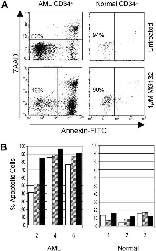 Fig. 4. MG-132 induces apoptosis in AML but not normal CD34+ cells. / Inhibitors of NF-κB induce apoptosis in AML but not in normal CD34+ hematopoietic cells. (A) Representative flow cytometric profile of primary AML cells (left panels) compared to normal cord blood cell (right panels) after a 6-hour treatment with or without 1 μM MG-132. Cells failing to label with annexin or the DNA dye 7-AAD represent viable cells (lower left). As apoptosis begins, cells start to label with annexin (lower right quadrant). As apoptosis proceeds, membrane integrity breaks down, and cells also label with 7-AAD (upper right quadrant). (B) Percent apoptotic cells in primary CD34+ AML cells (left panel, specimens 2, 4, and 6) compared to normal cord blood CD34+ cells (right panel) treated with 0.5 μM MG-132 (open bars), 1 μM MG-132 (hatched bars), or 1 μM MG-132 plus 5 mM sodium salicylate (dark bars).