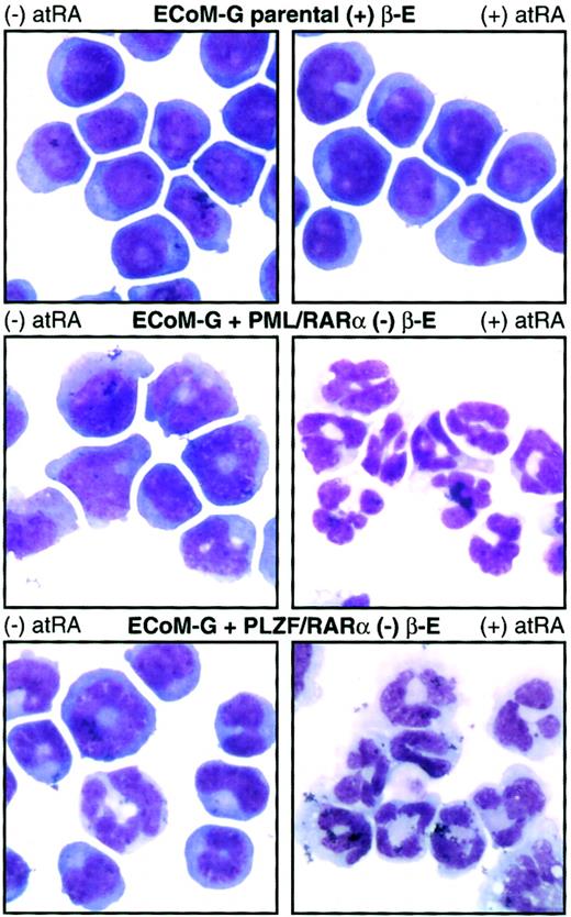 Fig. 7. PML/RARα and PLZF/RARα arrest ECoM-G differentiation in the absence of estrogen and endow the cells with RA sensitivity. / Derivatives of one ECoM-G clone were established by retroviral infection with constructs encoding PML/RARα and PLZF/RARα followed by selection of immortalized cells in the absence of estrogen. Parental ECoM-G cells (maintained in estrogen) as well as PML/RARα-immortalized and PLZF/RARα-immortalized cells (in the absence of estrogen) were treated for 4 days with 10 μM atRA. Table 1presents data from Wright-Giemsa stains of cytocentrifuge preparations, as well as the percent of mitotic progenitors and mature granulocytes compiled from a minimum of 200 cells.