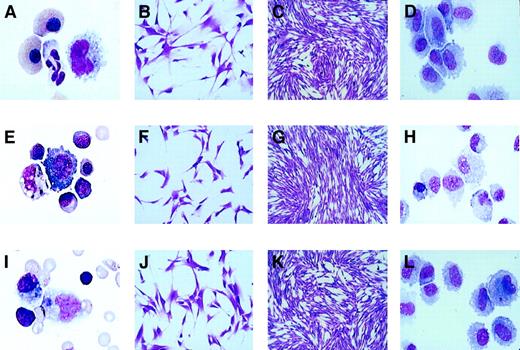Fig. 1. MSCs isolated and cultured in the first trimester. / A-D, fetal blood (9+2 weeks); E-H, fetal liver (10+2 weeks); and I-L, fetal bone marrow (11+2weeks. Cytospins of uncultured fetal blood (A), fetal liver (E), and fetal bone marrow (I) were stained with Leishman stain (× 1000 magnification). Three- and 8-day culture of a mesenchymal colony from fetal blood (B-C), fetal liver (F-G), and bone marrow (J-K) were stained with crystal violet (× 400 and × 100 magnification, respectively). Cytospins of a trypsinized MSC colony from fetal blood (D), fetal liver (H), and fetal bone marrow (L) were stained with Leishman stain (× 1000 magnification).