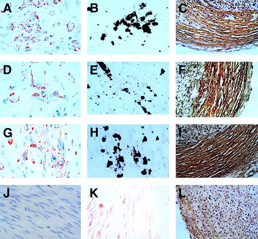 Fig. 5. Differentiation of fetal MSCs from into adipocytes, osteocytes, and chondrocytes. / First-trimester fetal blood (9+2 weeks; A-C), fetal liver (14+0 weeks; D-F), and fetal bone marrow (11+2weeks; G-I) into adipocytes, osteocytes, and chondrocytes. Adipogenic differentiation was indicated by accumulation of neutral lipid vacuoles that stained with Oil-red-O (A, D, and G, × 400 magnification), and such changes were not evident with human foreskin fibroblasts (J). Osteogenic differentiation was indicated by calcium deposition (B, E, and H, × 400 magnification), which stained with silver nitrate; this was not seen in foreskin fibroblasts (K). Chondrogenic differentiation was shown by staining with a monoclonal antibody to type 2 collagen and by the formation of lacunae (C, F, and I, × 400 magnification), not seen by similarly culturing human foreskin fibroblasts (L), which also produce collagen type 2.