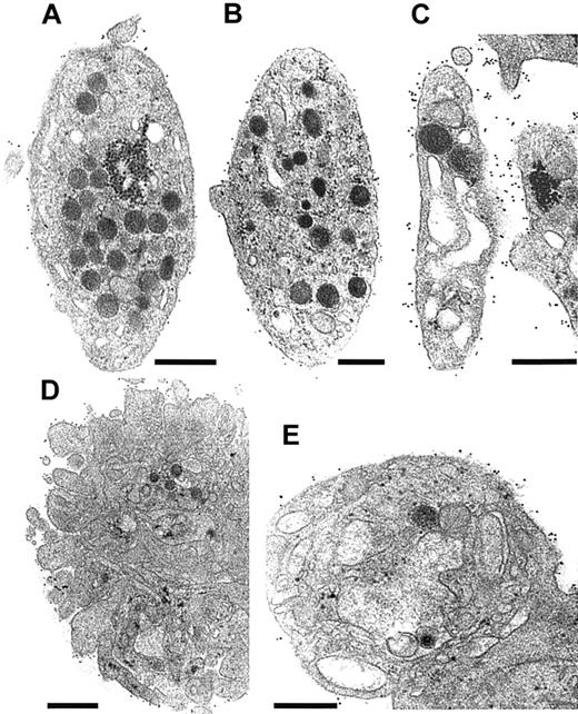 Fig. 5. Ultrastructural analysis of N.M.'s platelets. / All studies were performed on platelets fixed in PRP and incubated with rabbit antifibrinogen antibody (dilution 1:50) for 1 hour at RT. Bound antibodies were detected using a species-specific anti-IgG antibody (dilution 1:10) coupled to 10-nm gold particles overnight at 4°C before embedding. (A,D) Platelet sections are from a control donor. (B,C,E) Selected sections of platelets from patient N.M. (A) A nonstimulated control platelet is illustrated; few gold particles are present on the surface. (B) A platelet from N.M. shows a normal discoid shape and internal organization. Few gold particles are present at the platelet surface. (C) Another discoid platelet with larger vacuoles or a distended surface canalicular system is shown. The labeling for fibrinogen on the surface of this platelet was much more intense. (D) An example of TRAP6-activated control platelets (5 minutes). Even without continuous stirring, some aggregates have formed in the PRP, and labeling for fibrinogen is seen at the periphery of the aggregate. (E) TRAP6-activated platelets from the patient remained isolated or as small aggregates composed of 2 or 3 platelets; inside the platelet, large vacuoles are present and the granules have disappeared. Labeling at the platelet surface continues to be seen. Bars = 0.5 μm