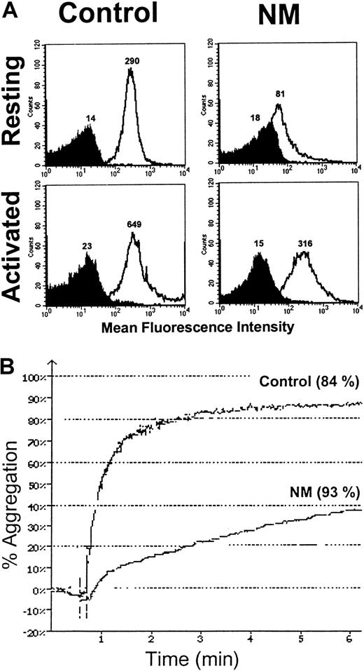 Fig. 9. Expression of the internal pool of GPIIb-IIIa on the patient's platelets and subsequent aggregation after TRAP6 activation. / (A) A total of 2 × 106 platelets in PRP were activated with 50 μM TRAP6. Platelets were then incubated with anti–GPIIb-IIIa antibody 6E1 (clear histogram) and isotype control (dark histogram) for 30 minutes at RT. After the addition of 1% formaldehyde in PBS, samples were analyzed by flow cytometry. The MFIs are indicated on the histograms. (B) Aggregation of N.M.'s platelets in PRP after secretion of the internal GPIIb-IIIa pool. Citrated PRP (2 × 108platelets/mL) was stimulated with 7 μM and 50 μM TRAP6 for the control and the patient, respectively. The values (percent of maximal secretion) for PF4 release, as assessed with an ELISA, are in parentheses.