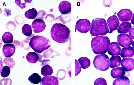 Fig. 1. Comparison of the morphology of hematogones and neoplastic lymphoblasts in bone marrow smears. / (A) Several hematogones are illustrated in this bone marrow smear from a 3-year-old boy with immune thrombocytopenia. They bear close resemblance to the neoplastic lymphoblasts illustrated in panel B. (B) Numerous lymphoblasts are present in this bone marrow smear from a 5-year-old girl with precursor B-ALL.