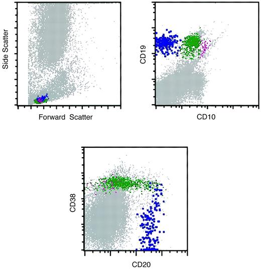 Fig. 4. Flow cytometry histograms of a marrow specimen with increased hematogones. / The histograms illustrate the normal pattern of maturation of B-lymphocyte precursors (hematogones) with the 4-color antibody combination of CD10, CD20, CD19, and CD38. The CD10-CD20 histogram was similar to the one illustrated in Figure 3. Violet indicates early-stage hematogones; green, intermediate and late-stage hematogones; blue, mature B cells.