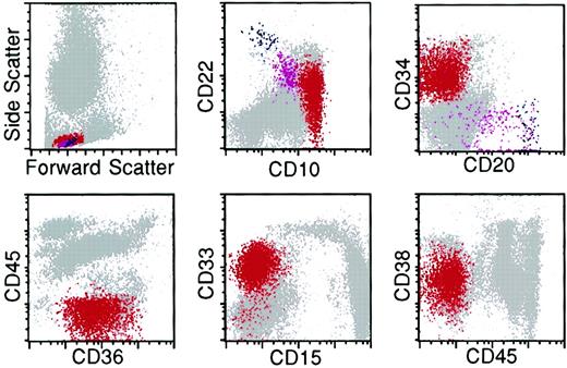 Fig. 9. Flow cytometry histograms of bone marrow from a patient with relapse of precursor B-ALL illustrating multiple antigenic aberrancies. / The lymphoblasts (red) exhibit an abnormal spectrum of expression of CD22 and overexpression of CD10 relative to the normal hematogone population (violet). They are uniformly CD34-positive and -negative for CD20 and CD45. The lymphoblasts express the myeloid-associated antigens CD36 and CD33 and underexpress CD38. Red indicates neoplastic lymphoblasts; violet, hematogones; and blue, mature B lymphocytes.
