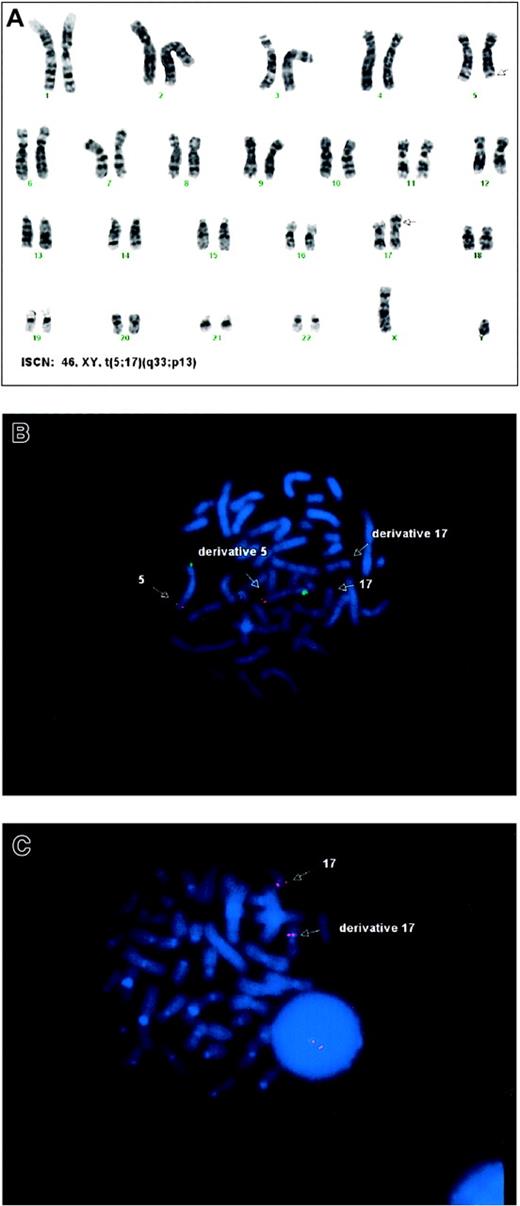 Fig. 1. Cytogenetic analyses. / (A) G-banded karyotype from bone marrow showing the t(5;17)(q33;p13). (B) Metaphase FISH demonstrating that the LSI CSF1R SpectrumOrange/D5S721, D5S23 SpectrumGreen (VYSIS) dual-color probes are present on the normal and derivative chromosomes 5. (C) Metaphase FISH demonstrating the LSI p53 SpectrumOrange (VYSIS) probe is present on both the normal and derivative chromosomes 17.