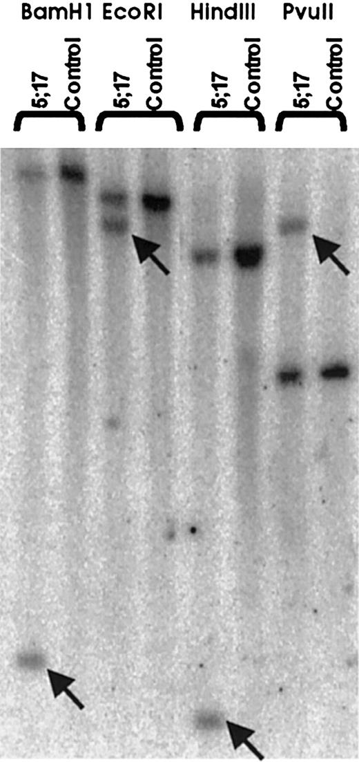 Fig. 2. Translocation of. / PDGFβR gene in patient-derived genomic DNA.Patient and normal control genomic DNA was restriction enzyme digested (BamHI, EcoRI, HindIII, andPvuII), electrophoretically separated, and transferred to a nitrocellulose membrane. Southern blotting was performed using a 1.1-kb (HindIII-XhoI fragment) genomic PDGFβR probe (see “Patient and methods”). Arrows indicate patient-specific bands, showing translocation involving the PDGFβRgene.