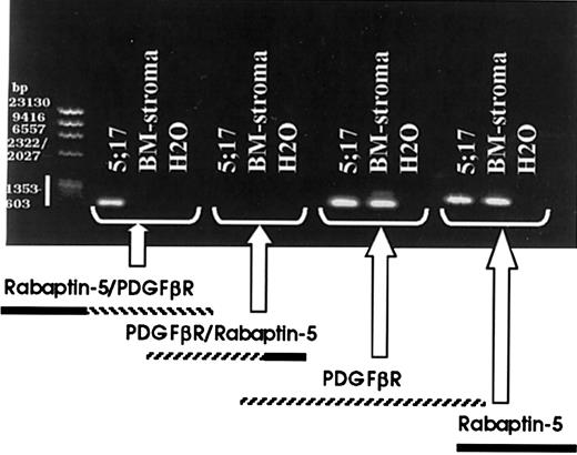 Fig. 4. RT-PCR identifies the patient specific 5′ Rabaptin-5/PDGFβR 3′ fusion breakpoint, but not the reciprocal breakpoint. / RT-PCR was carried out on patient myeloid cell total RNA and normal donor bone marrow stroma total RNA, using primers to identify the 2 potential breakpoint products, 5′ Rabaptin-5/PDGFβR 3′ and 5′ PDGFβR/Rabaptin-5 3′, as well as the 2 involved native gene products.
