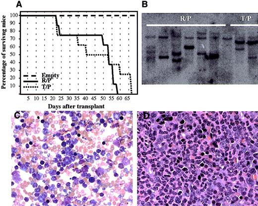 Fig. 7. Rabaptin-5/PDGFβR retrovirally transduced into murine bone marrow causes a fatal myeloproliferative disease. / (A) Survival of lethally irradiated mice receiving bone marrow transplants transduced with empty plasmid, Rabaptin-5/PDGFβR (R/P), or tel-PDGFβR (T/P) containing retroviruses. (B) Southern blot of splenic genomic DNA using an eGFP probe demonstrating proviral integration with several bands detected in samples from 6 mice receiving transplants with Rabaptin-5/PDGFβR (R/P) and 3 mice with tel/PDGFβR. (C) A representative peripheral blood smear from a mouse with the rabaptin-5/PDGFβR-mediated myeloproliferative disease (× 400) revealing marked leukocytosis with predominantly mature granulocytes. (D) Formalin-fixed, hematoxylin and eosin-stained spleen sections from a mouse with Rabaptin-5/PDGFβR-mediated myeloproliferative disease (× 400) revealing near total replacement of normal spleen architecture by mature granulocytes.