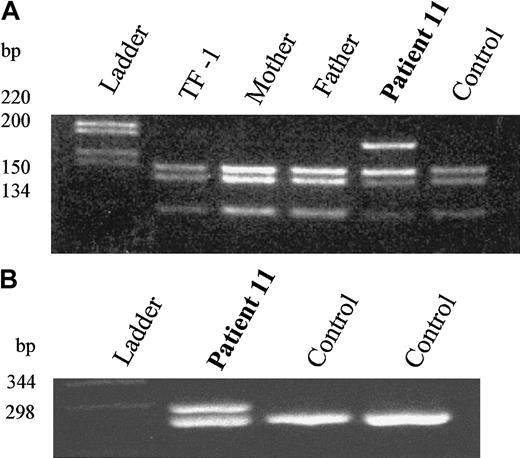 Fig. 1. Molecular analysis of DNA and RNA from an SCN patient with an. / ELA2 mutation. (A) AciI restriction enzyme digestion demonstrating heterozygosity in patient 11 and wild-type alleles in the parents. C4477A mutation removes a cleavage site for the enzyme AciI. (B) RT-PCR analysis demonstrating equivalent amounts of the normal and mutant mRNA. Splice acceptor mutation leads to insertion of 6 bp in the mRNA transcript.