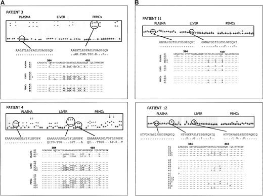 Fig. 4. HCV quasi-species analysis in different compartments from patients with and without HVR1 aa insertion. / (A) Analysis of HCV quasi species in plasma, liver, and PBMC2s of 2 patients with MC2 (patients 3 and 4) in whom an HVR1 aa insertion was detected. Upper panels illustrate the CFA profiles of HVR1 quasi-species variants isolated from the 3 different tissues. For each patient, one clone representing a plasma major variant was labeled with 32P and hybridized to 20 HVR1 clones from each of the 3 compartments. In each panel, lane 1 shows the homoduplex control, and lanes 2 to 21 show gel shift patterns of the 20 independent cDNA clones. Gel shift patterns representative of different HVR1 variants and their corresponding aa sequences are indicated. Below, deduced aa sequences of clones from the 3 tissues, selected on the basis of the CFA results, are reported. The 385 insertion, found in all the HCV variants from these patients, is indicated by an underlined letter. Dots indicate aa identity to plasma-derived probe. (B) Analysis of HCV quasi species in plasma, liver, and PBMC2s of 2 patients with MC2 (patients 11 and 12) with no sequence mutations in the HVR1. Upper panels illustrate the CFA profiles of HVR1 quasi-species variants isolated from the 3 different tissues. In each panel, lane 1 shows the homoduplex control, and lanes 2 to 21 show gel shift patterns of the 20 independent cDNA clones. Below, aa sequences of selected clones from the 3 compartments are aligned to the sequence of the CFA probe derived from plasma major variant.