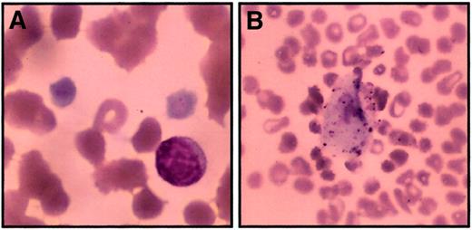 Fig. 2. Peripheral smear from thrombocytopenic members. / Peripheral blood smears were stained with Wright-Giemsa stain and examined by light microscopy to determine platelet morphology. These photomicrographs demonstrate macrothrombocytes (A) (original magnification, 1000 ×) and a rare circulating megakaryocyte fragment (B) (original magnification, 200 ×). Red blood cell morphology in these images is distorted in part due to dyserythropoiesis and partially because of the age of the sample when smears were made (24 hours).